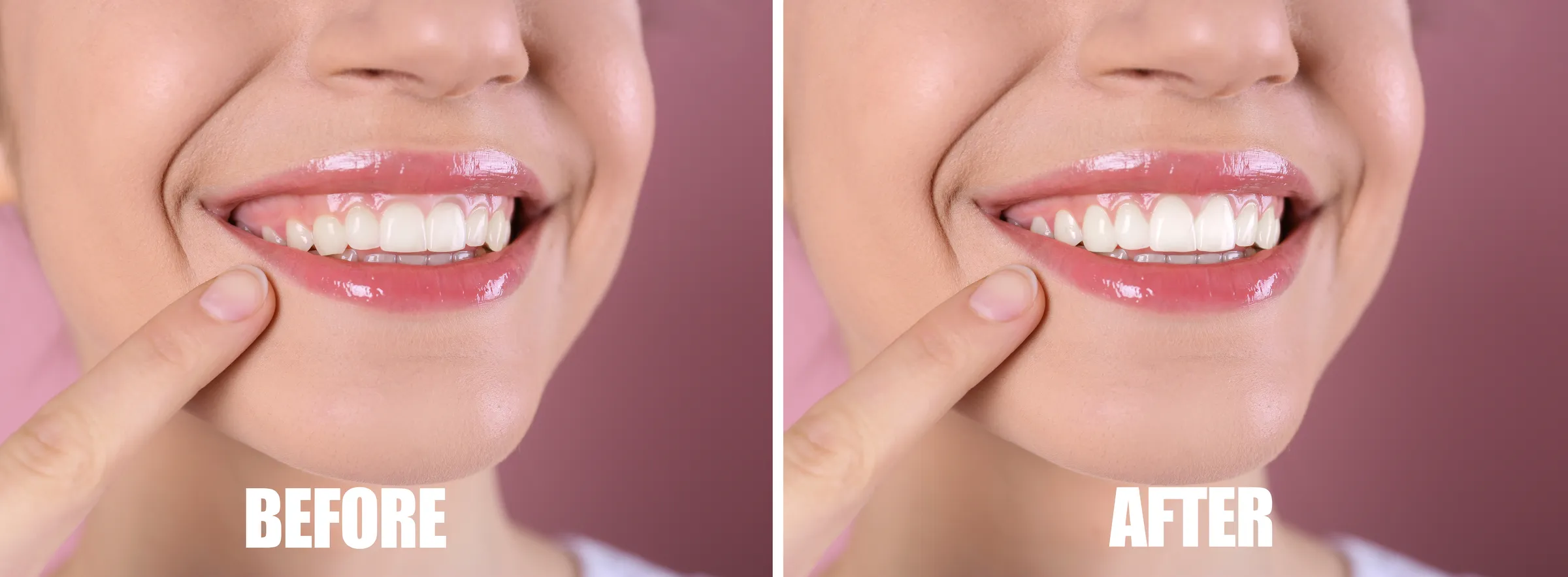 Gum contouring consultation at Dental Studio of Marin
