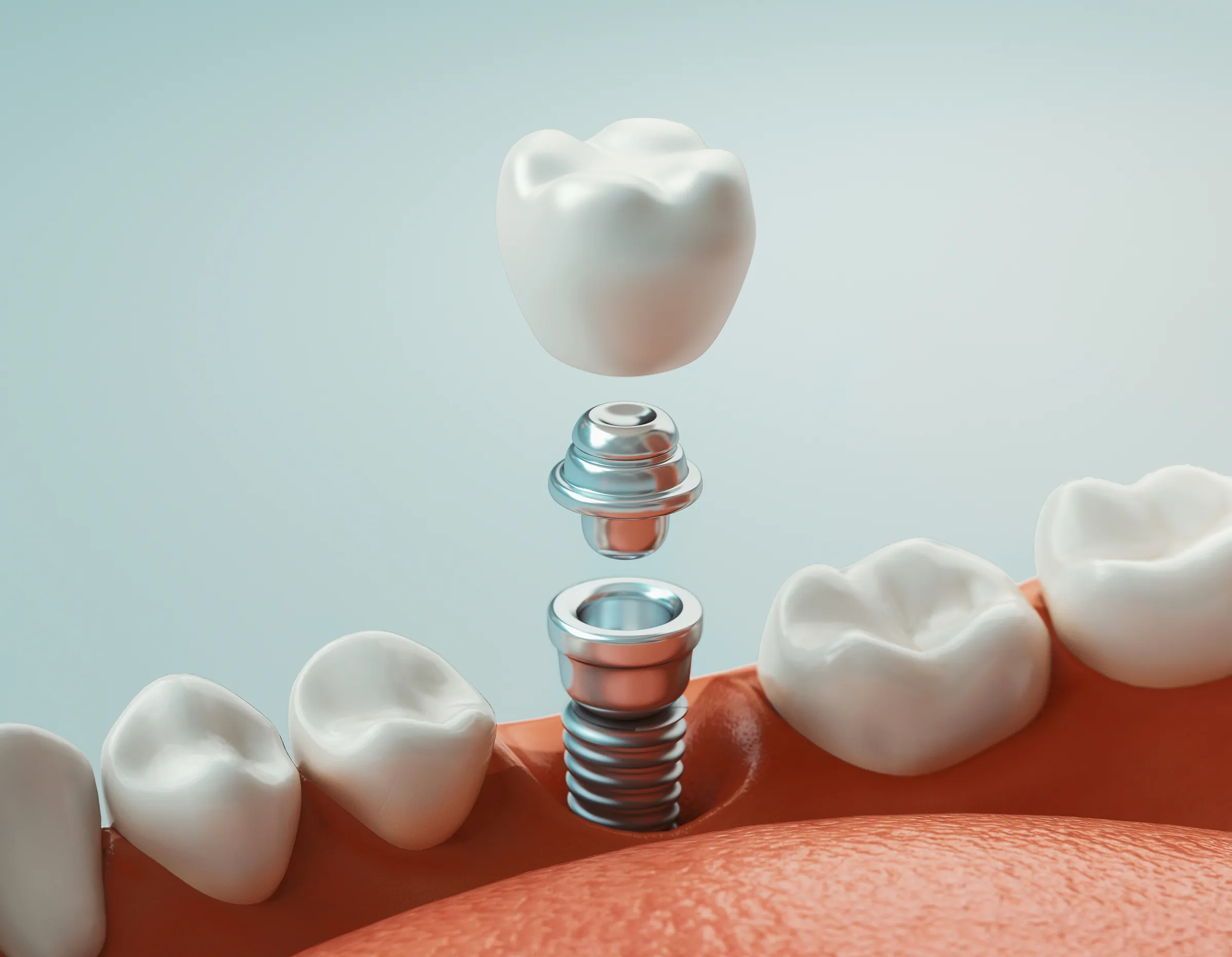 Dental implants at Dental Studio of Marin