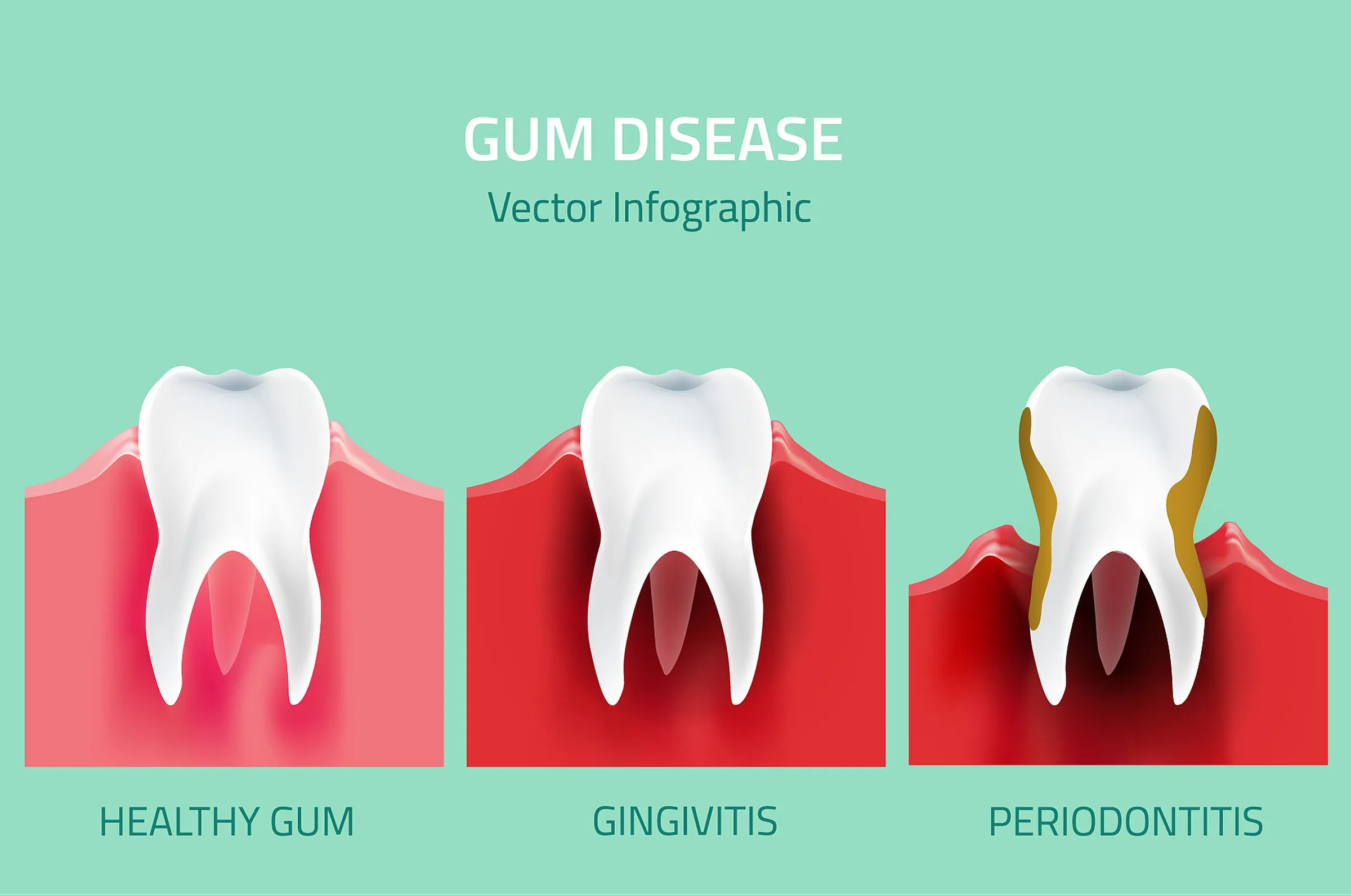 Periodontal maintenance cleaning at Dental Studio of Marin