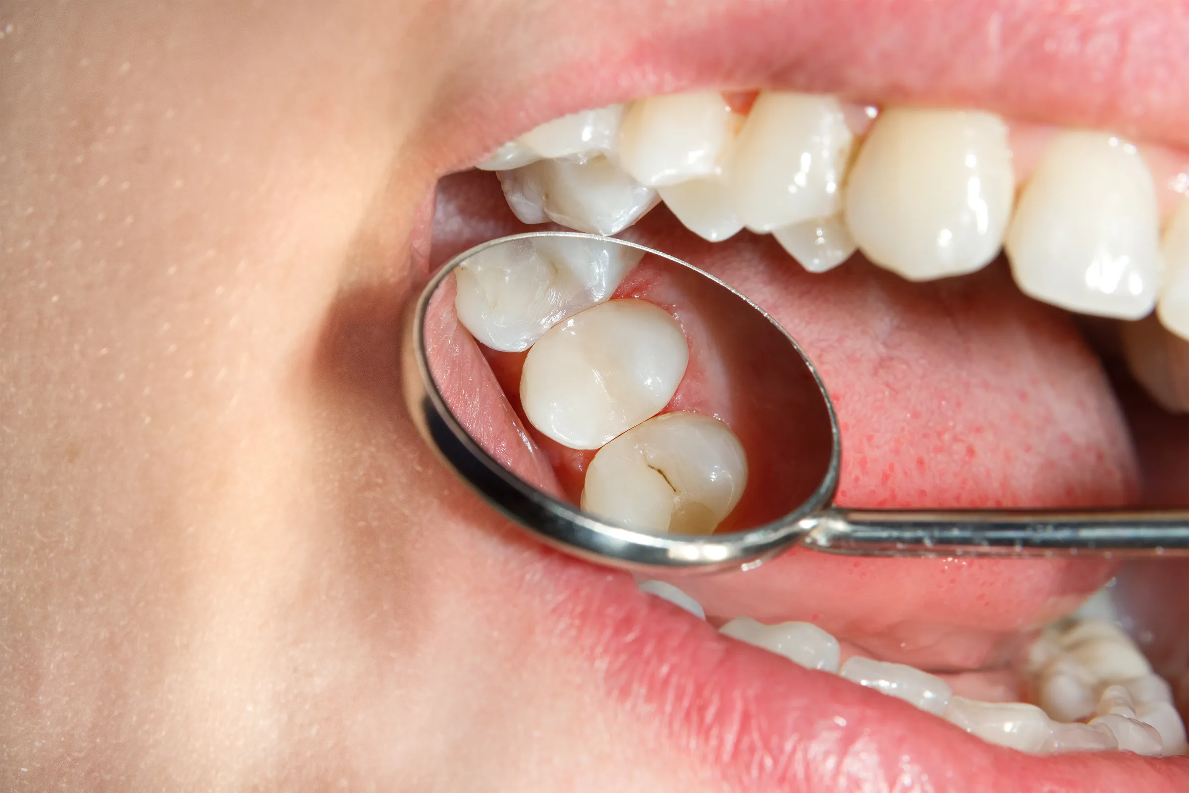 Young patient receiving preventive dental care at Dental Studio of Marin