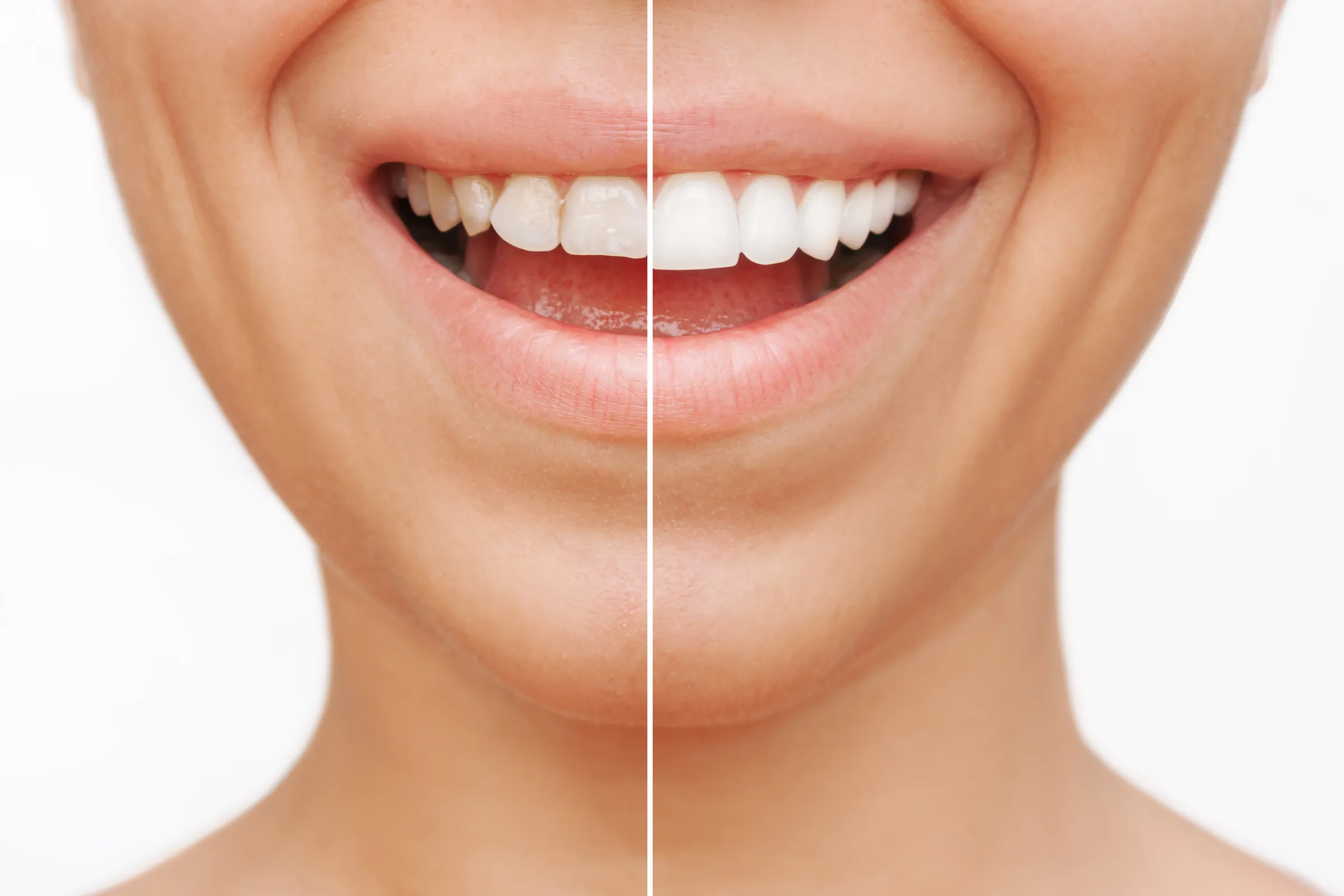 Custom veneers at Dental Studio of Marin